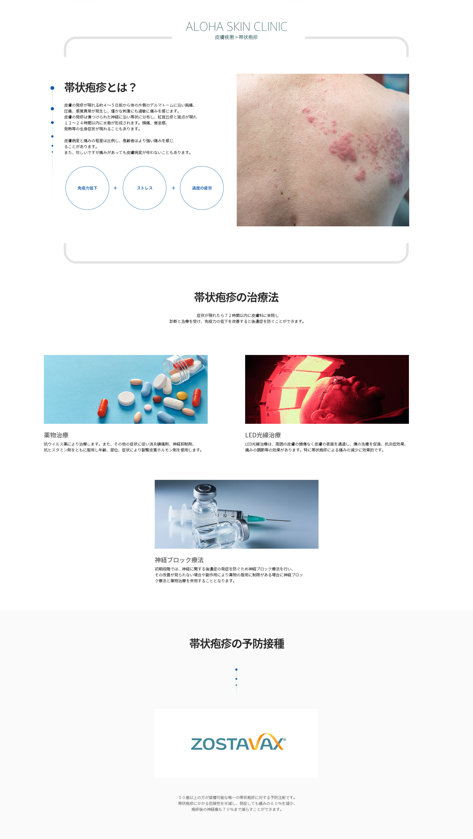 帯状疱疹